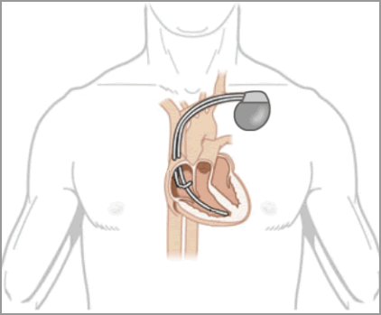 single chamber vs dual chamber pacemaker single chamber vs dual chamber pacemaker